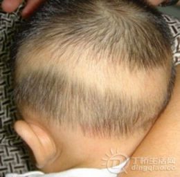 枕秃.jpg 枕秃.jpg